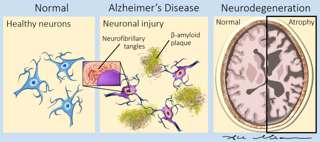 Alzheimer early cortical changes illustrated in neuronal damage and brain atrophy