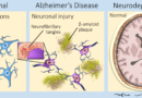 Alzheimer early cortical changes illustrated in neuronal damage and brain atrophy