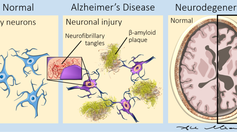 Alzheimer early cortical changes illustrated in neuronal damage and brain atrophy